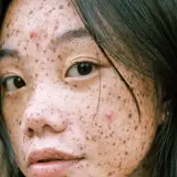 Primer plano de una joven con pecas y una mancha abultada en la cara, con cabello oscuro cayendo sobre su rostro.