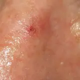 Lesión cutánea en la nariz, posiblemente queratosis actínica, con enrojecimiento y descamación.