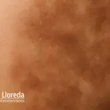 Piel con hiperpigmentación postinflamatoria, mostrando manchas oscuras y textura irregular. Logo de Dr. Juan Carlos Lloreda.