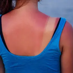 Espalda con piel quemada por el sol, mostrando un bronceado desigual y enrojecimiento.