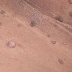 Primer plano de verrugas en las axilas, algunas de ellas con aspecto carnoso y otras más pequeñas y oscuras.