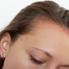 Marcas rojas y descamación en la línea del cabello, sugiriendo foliculitis cuero cabelludo.