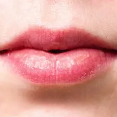 Labios rojos y agrietados, con aspecto de labios quemados por el sol, mostrando sequedad y descamación.