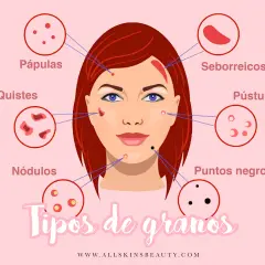 Ilustración que muestra diferentes tipos de granos en la cara: pápulas, quistes, nódulos, seborreicos, pústulas y puntos negros.