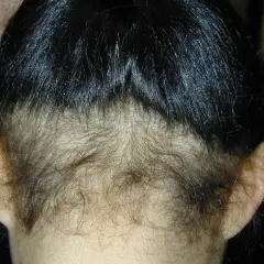 Vista posterior de una cabeza con cabello oscuro y lacio, mostrando una zona de poca densidad de pelo en la nuca y alrededor de las orejas.