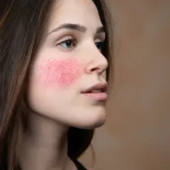 Mujer con rubor facial intenso y visible en las mejillas, mostrando la piel enrojecida y con pequeños vasos sanguíneos.