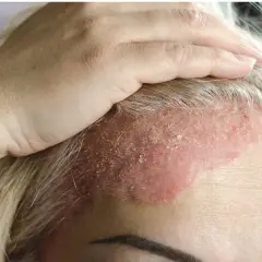 Una mano toca la frente de una mujer con dermatitis en la cara, mostrando piel enrojecida y escamosa.