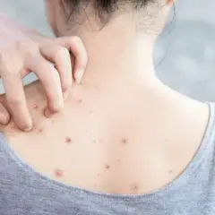 Una persona se rasca la espalda, mostrando varias espinillas gigantes que le causan picazón.