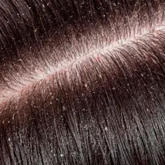 Primer plano del cuero cabelludo con cabello oscuro y escamas blancas, indicando varios tipos de caspa en la cabeza.