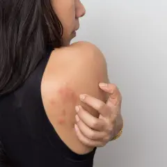 Mujer se rasca el hombro, mostrando ronchas rojas en la piel que pican.