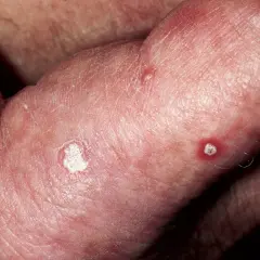 Piel enrojecida con escamas blancas y pequeñas lesiones, indicativas de queratosis solar.