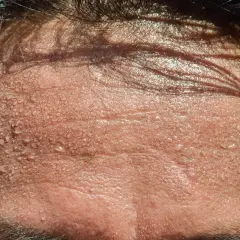 Frente sudorosa, buscando remedios caseros para evitar el sudor en la cabeza. Gotas de sudor brillan en la piel.