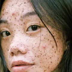 Primer plano de una joven con pecas y una mancha abultada en la cara, con cabello oscuro cayendo sobre su rostro.