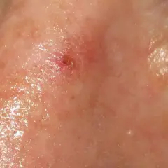 Lesión cutánea en la nariz, posiblemente queratosis actínica, con enrojecimiento y descamación.