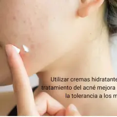 Una persona aplica crema hidratante en su rostro con acné. Es bueno echarse crema hidratante en los granos para mejorar el tratamiento.