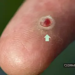 Un dedo con una lesión que parece un punto negro infectado, con un círculo blanco alrededor y una flecha verde apuntando hacia el centro.