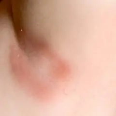 Axila con piel enrojecida y engrosada, indicativo de acantosis nigricans. El tratamiento busca mejorar la apariencia y salud de la piel.