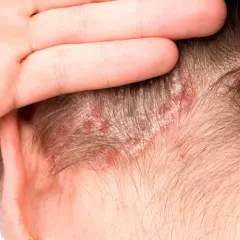 Primer plano de un cuero cabelludo con escamas blancas y enrojecimiento, indicativo de enfermedades del cuero cabelludo.