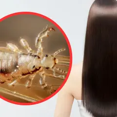 Primer plano de un piojo en un cabello liso y oscuro. Los piojos saltan y se reproducen rápidamente.