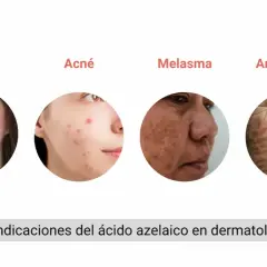 El ácido azelaico sirve para tratar rosácea, acné, melasma y arrugas. Muestra rostros con estas afecciones.