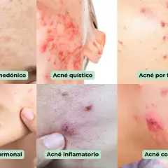 Seis imágenes muestran diferentes tipos de acné: comedónico, quístico, por fricción, hormonal, inflamatorio y<bos> conlobata.