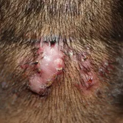 Lesión cutánea con varios granos en el cuello, rodeada de vello oscuro.
