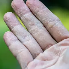 Dedos con piel seca y agrietada, mostrando síntomas de eccema dishidrótico.