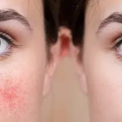 Comparación de piel: antes y después del tratamiento para la cuperosis que es una afección cutánea.
