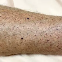 Primer plano de la piel de una pierna con numerosos puntos rojos y morados, mostrando diferentes tipos de manchas en las piernas.
