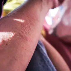 Brazo con erupción cutánea y ampollas, indicando una posible reaccion alergica al sol.