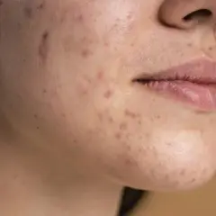 Primer plano de una cara con acné, mostrando cómo quitar granos de la cara y mejorar la piel.
