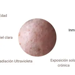 Lesiones en la piel que sugieren queratosis actínica, asociadas a edad, piel clara, radiación UV e inmunosupresión.