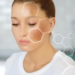 Rostro de mujer con manchas oscuras, ilustrando la melanina que es el pigmento de la piel. Estructura molecular superpuesta.
