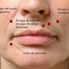 Primer plano de un rostro femenino mostrando arrugas del surco nasogeniano, líneas de marioneta y arrugas de fumador.
