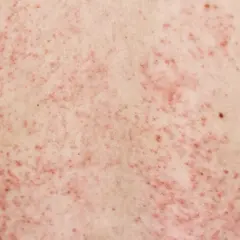 Primer plano de un sarpullido en la espalda, con numerosas protuberancias rojas y pequeñas que cubren la piel.