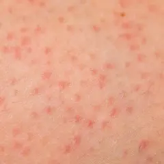 Piel con pequeñas protuberancias rojas y ásperas, indicativo de queratosis pilaris.