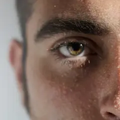 Ojos y frente de un hombre con gotas de sudor visibles, evidencia de hiperhidrosis facial.