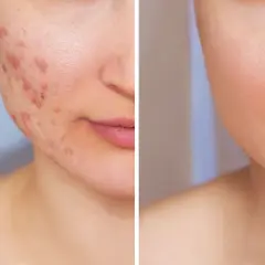 Comparación de piel con acné y piel clara. Descubre cómo el limon es bueno para la cara y mejora su apariencia.