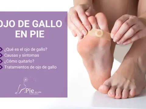 Ojo de gallo en el pie - cómo aliviarlo y evitar que vuelva