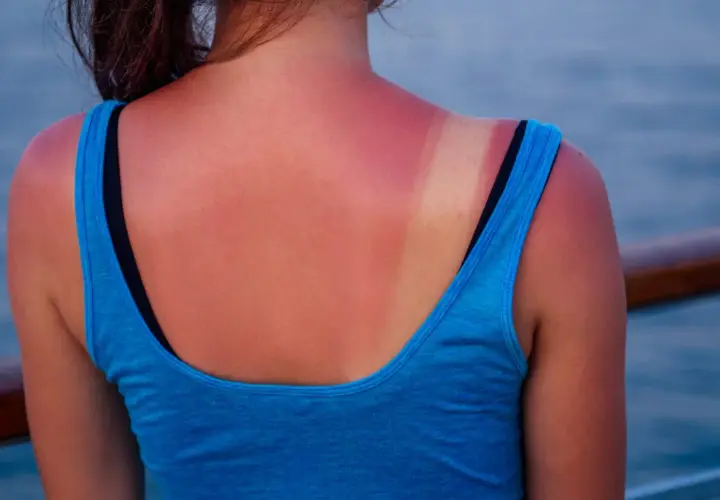 Espalda con piel quemada por el sol, mostrando un bronceado desigual y enrojecimiento.