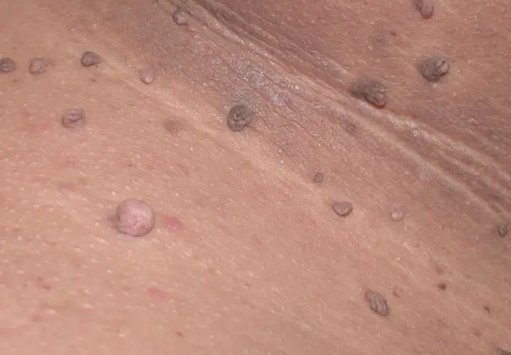 Primer plano de verrugas en las axilas, algunas de ellas con aspecto carnoso y otras más pequeñas y oscuras.