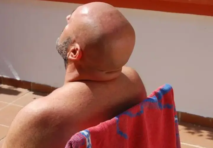 Hombre calvo con cuero cabelludo quemado por el sol, inclina la cabeza hacia atrás bajo el sol abrasador.