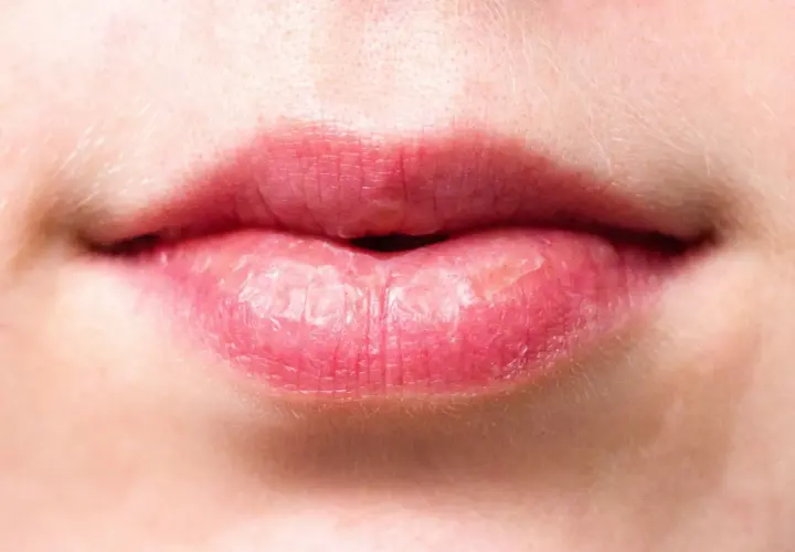 Labios rojos y agrietados, con aspecto de labios quemados por el sol, mostrando sequedad y descamación.