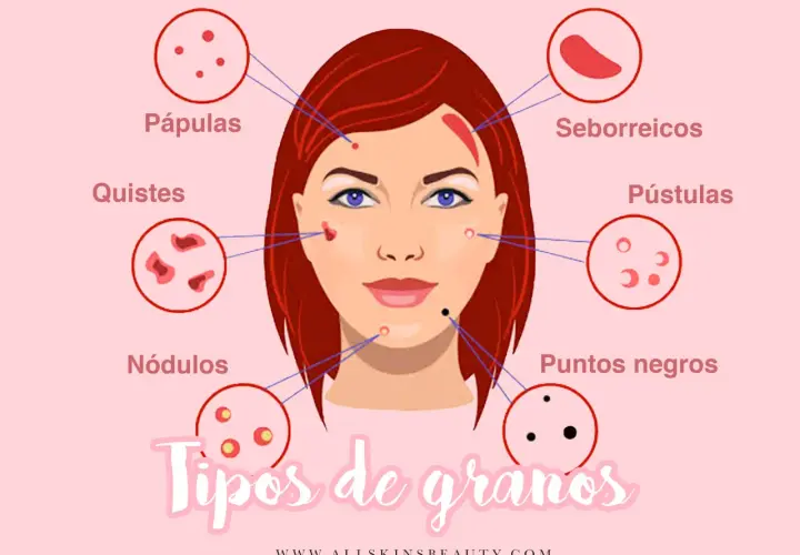 Ilustración que muestra diferentes tipos de granos en la cara: pápulas, quistes, nódulos, seborreicos, pústulas y puntos negros.