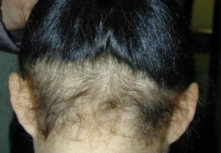 Vista posterior de una cabeza con cabello oscuro y lacio, mostrando una zona de poca densidad de pelo en la nuca y alrededor de las orejas.