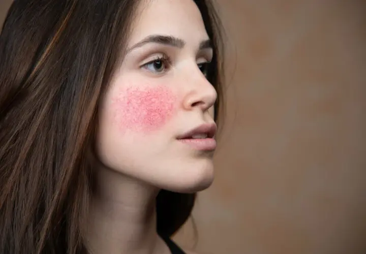 Mujer con rubor facial intenso y visible en las mejillas, mostrando la piel enrojecida y con pequeños vasos sanguíneos.