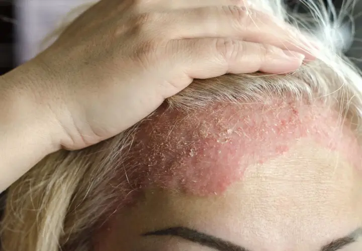 Una mano toca la frente de una mujer con dermatitis en la cara, mostrando piel enrojecida y escamosa.
