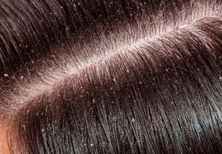 Primer plano del cuero cabelludo con cabello oscuro y escamas blancas, indicando varios tipos de caspa en la cabeza.