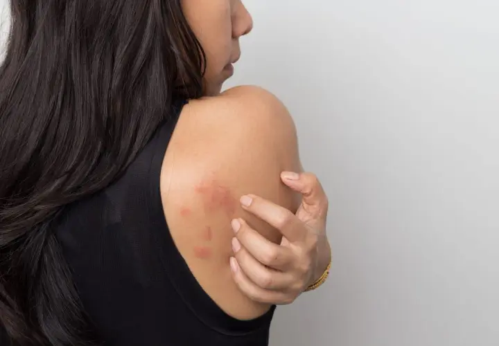 Mujer se rasca el hombro, mostrando ronchas rojas en la piel que pican.