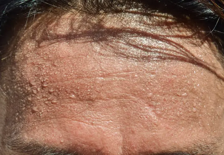 Frente sudorosa, buscando remedios caseros para evitar el sudor en la cabeza. Gotas de sudor brillan en la piel.